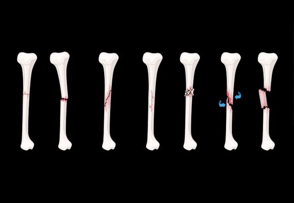 أنواع كسور العظام وأسبابها وطرق علاجها