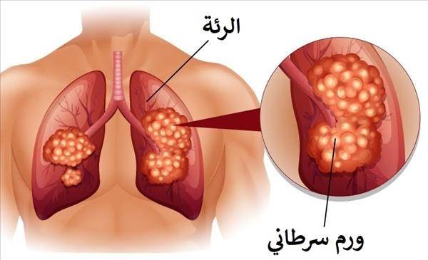 سرطان الرئة الأعراض، الأسباب والعلاج