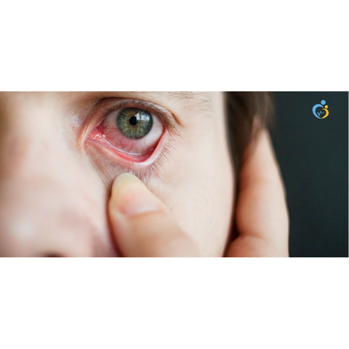 ما هي أسباب احمرار العين وما هي طرق علاجه