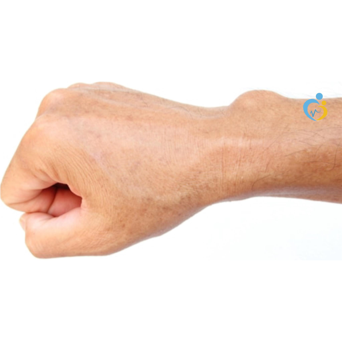 ملف تعريفي بالأكياس الدهنية