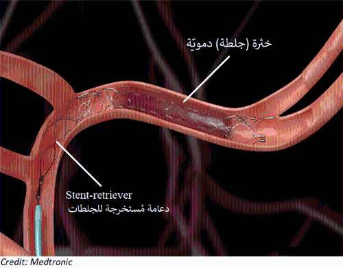 جلطه بالدماغ