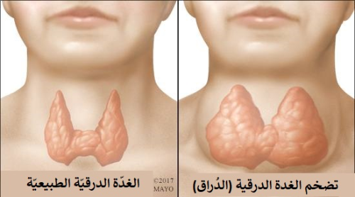 تضخم الغدة الدرقية الأسباب والعلاج